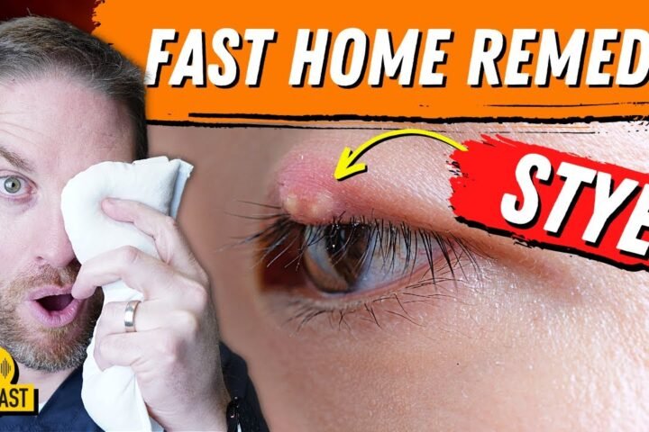 How to Get Rid of a Stye Overnight